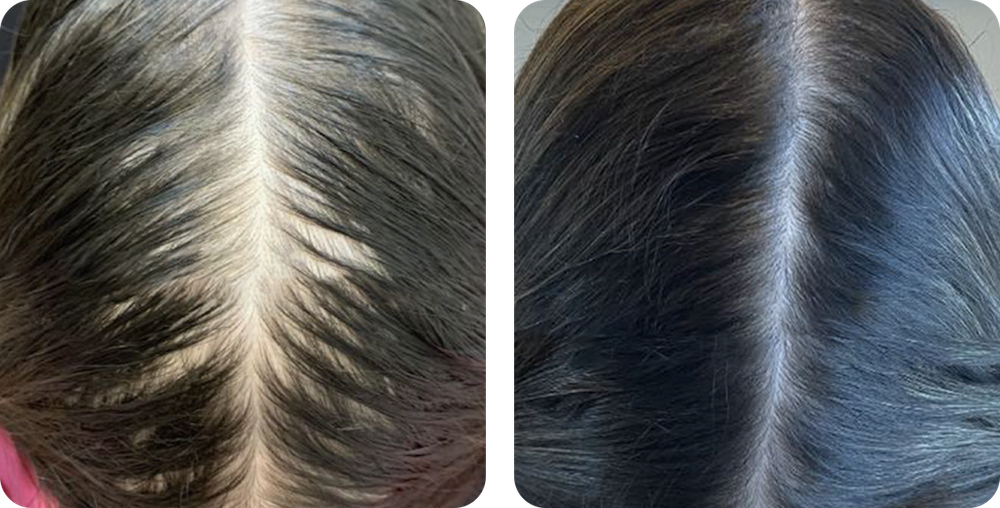 Antes e depois do cuidado capilar em paciente feminina
