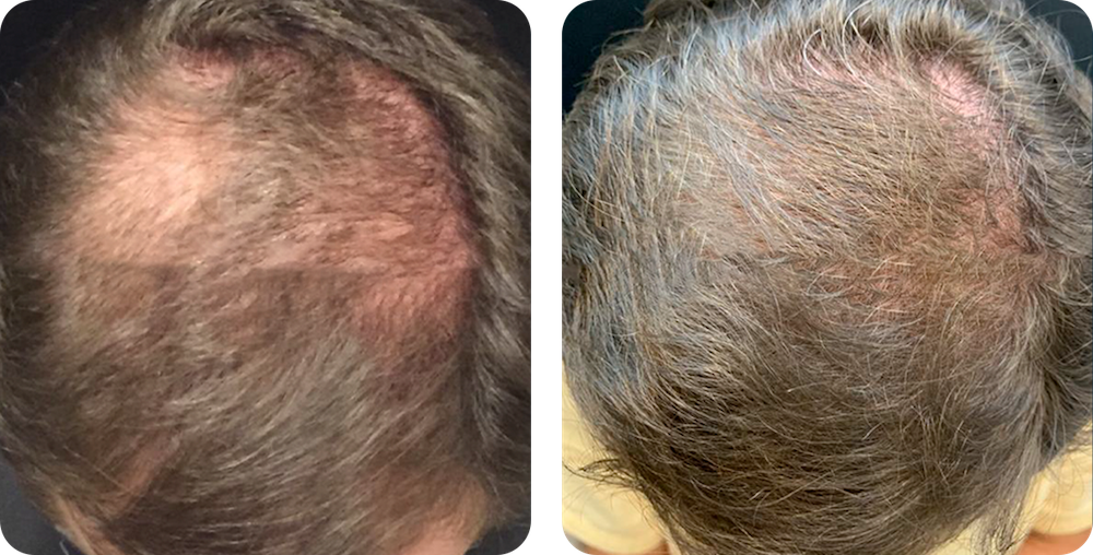 Antes e depois do cuidado capilar em paciente masculino